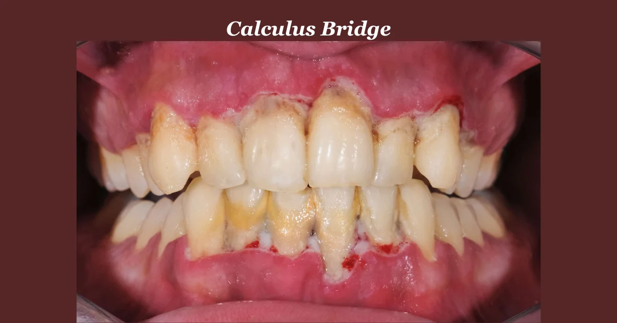 Calculus Bridge: Prevention Tips and Treatment Options Explained